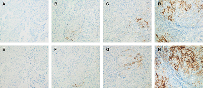 Representative immunohistochemical staining for PD-L1 (x200).