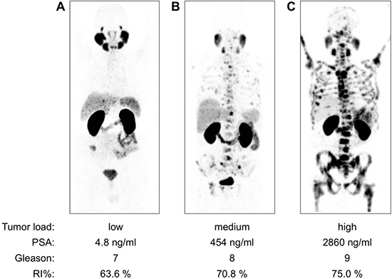 Examples of Ga-68-PSMA-11 PET/CT examinations (MIP projections, SUV 0&#x2013;12) in patients with low, medium and high tumor load.