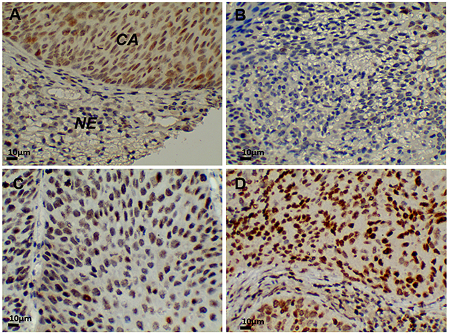 G9a expression in cervical cancer tissue (400x).