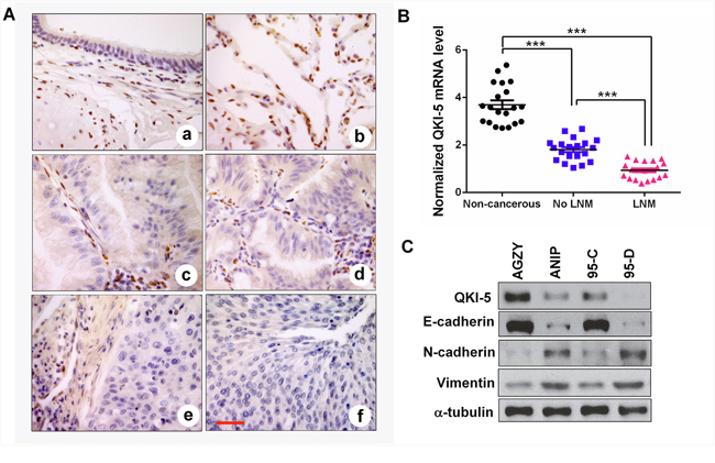 QKI-5 downexpression in human LC tissues and cell lines with metastasis is accompanied by EMT.