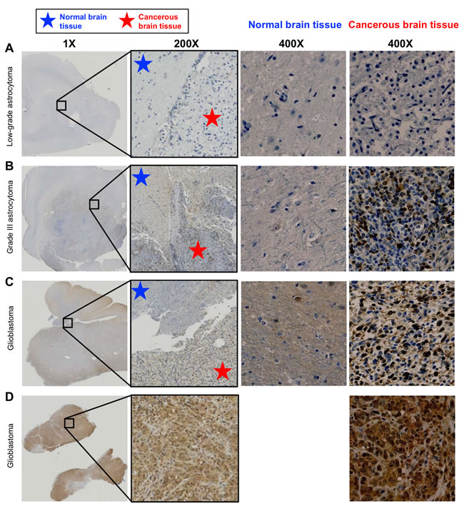 Procaspase-3 immunohistochemical staining of spontaneous canine astrocytomas.