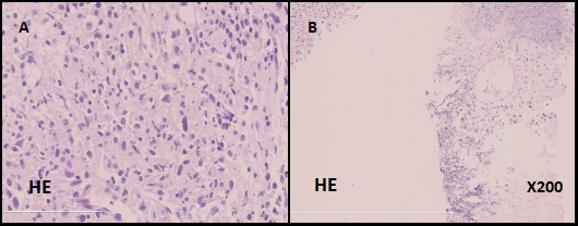 Microscopic findings of the patient's lung biopsy specimen.