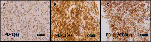 The IHC staining of PD-1 , PDL-1 and PDL-1/CD8 in the patient's lung biopsy specimen.