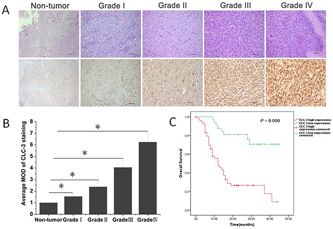 CLC-3 protein was overexpressed in glioma histopathological sections.