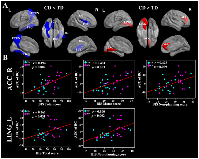 Brain regions showing disrupted nodal network properties in brain functional networks in CD group and their relationships with clinical variables.