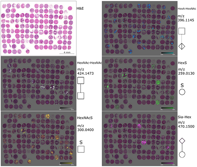 Ion maps of different glycan fragments analyzed in the gastric cancer tissue microarray.