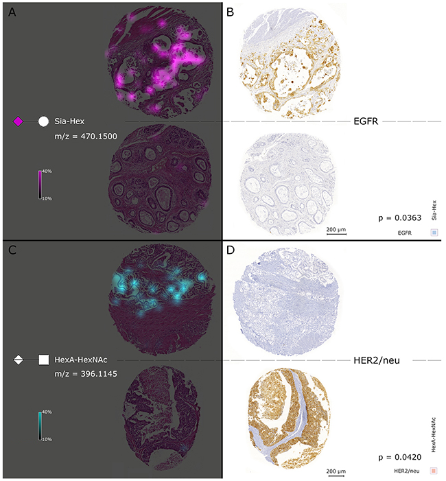 Simultaneous consideration of MALDI FT-ICR-MSI and results of the EGFR and HER2/neu immunohistochemical staining.