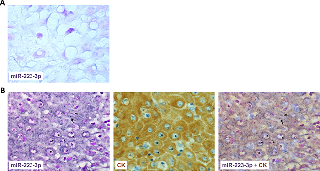 miR-223-3p is overexpressed in head and neck cancer.