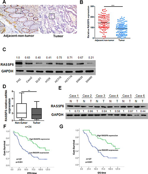 RASSF6 is downregulated in CRC cell lines and patient tumour tissues and has prognostic value in patients with CRC.
