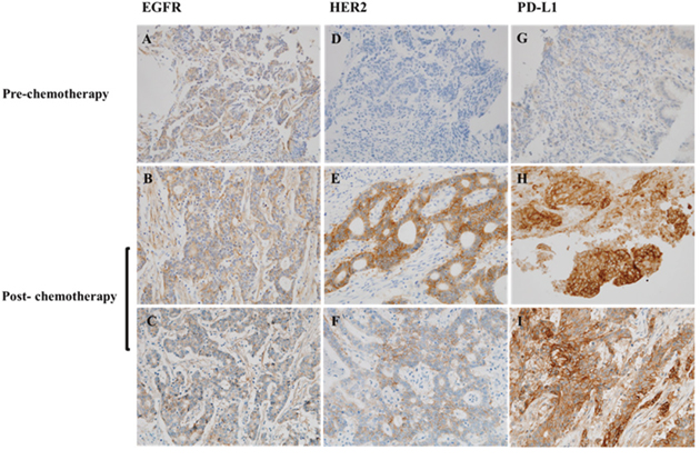 Immunohistochemistry analysis of the paired tumor specimens of pre-chemotherapy and post-chemotherapy.