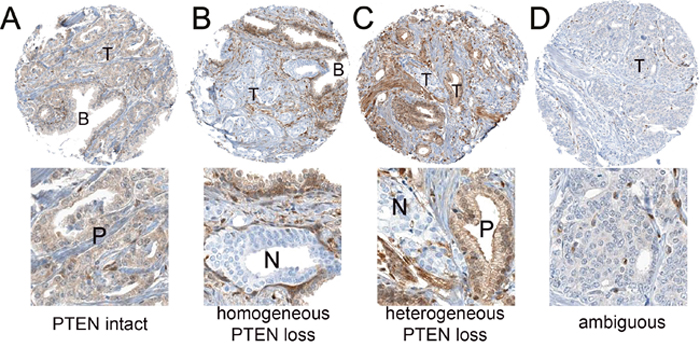 Representative PTEN immunohistochemistry results.