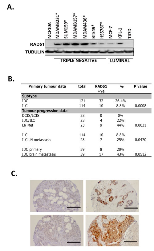 High RAD51 expression is observed in basal breast cell lines and metastatic patient samples.