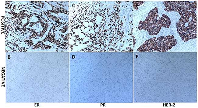 The representative immunohistochemistry (IHC) results of ER, PR and HER-2 expression in breast cancer (original magnification &#x00D7;100).