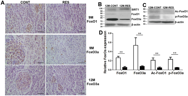 Resveratrol induced apoptosis by down-regulation of FoxO1 and FoxO3a, deacetylation and dephosphorylation of FoxOs with SIRT1 up-regulation.