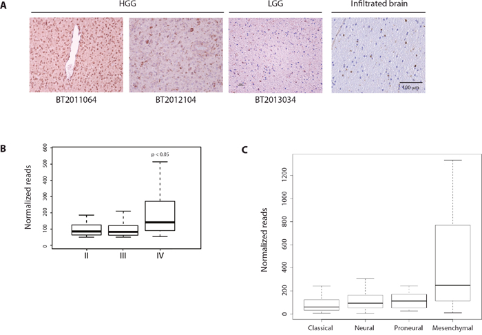 Cox-2 is expressed in human glioblastoma.