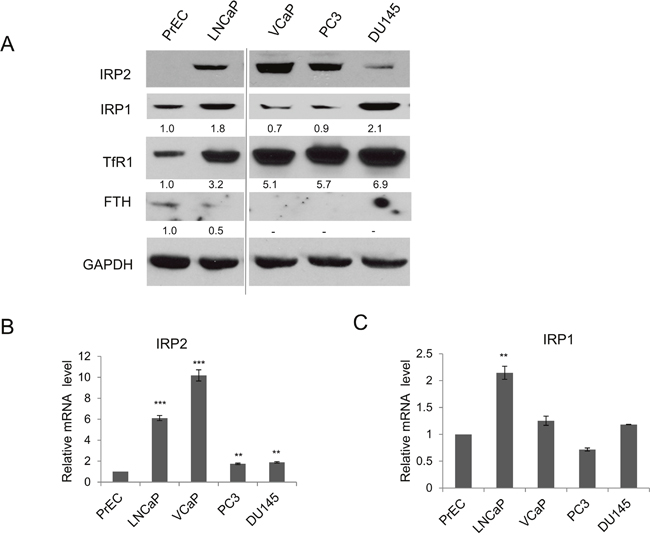 IRP2 is overexpressed in prostate cancer cells.