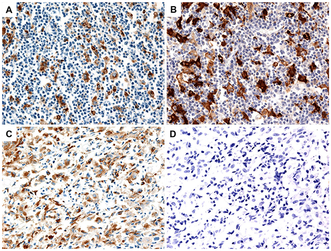 Representative images of high and low infiltration of CD68-positive and CD163-positive macrophages in tumor tissue.