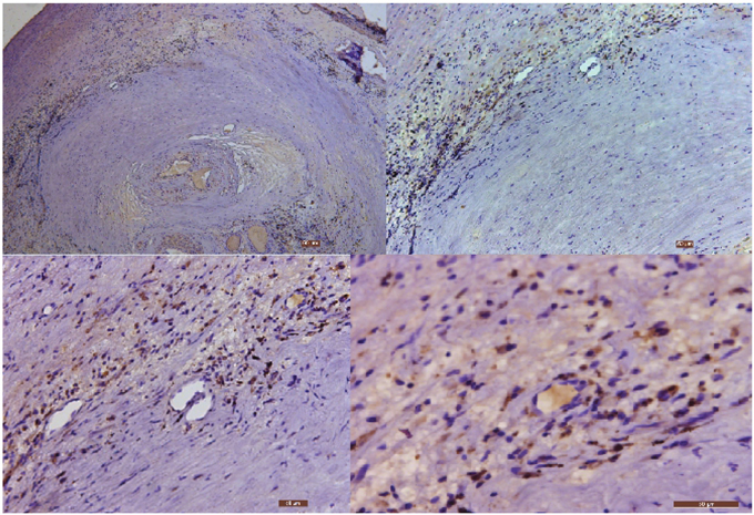 The immunohistochemical staining results of Cpn in carotid atherosclerotic plaque (40&#x00D7;, 100&#x00D7;, 200&#x00D7; and 400&#x00D7;, respectively).