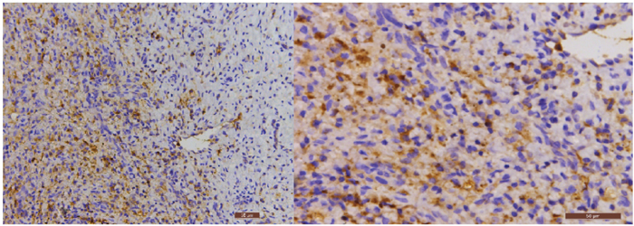 The immunohistochemical staining results of CMV in carotid atherosclerotic plaque (200&#x00D7; and 400&#x00D7;, respectively).