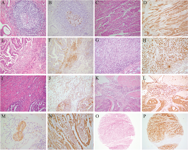 PD-1, PD-L1, and PD-L2 expression in TCs and TIICs of GC patients.