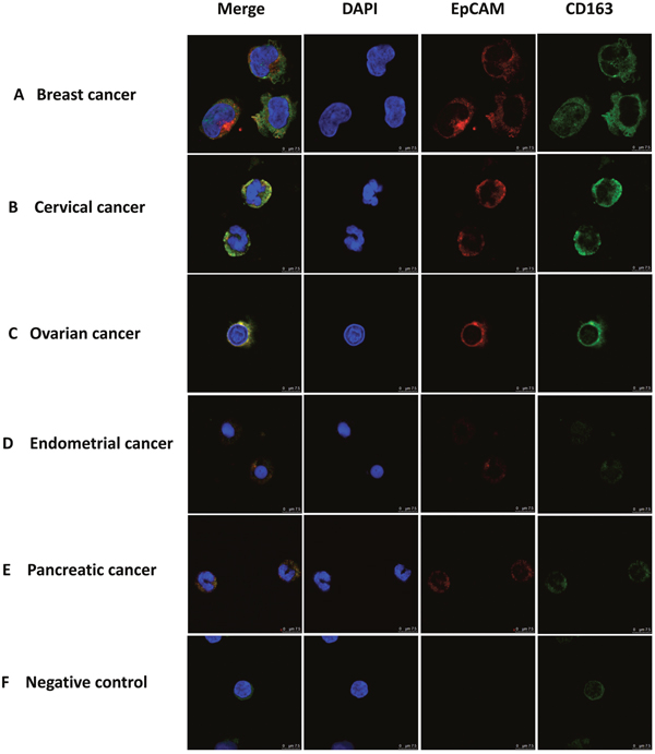 Immuno-staining of monocytes from patients with different types of epithelial cancers.