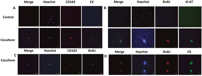 hMDMs reutilize tumor DNA and transform into epithelial-proliferative tumor-like cell retaining M2 marker expression.