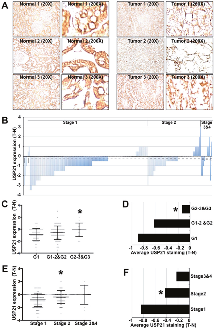 USP21 expression in kidney tumors and adjacent matched normal tissues.