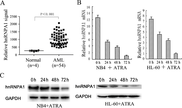 The expression levels of hnRNP A1 in AML patients and normal persons and during ATRA-induced granulocytic differentiation of NB4 and HL-60.