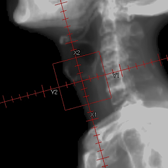 Radiotherapy field for the T3N0 glottic carcinoma without cord fixation.