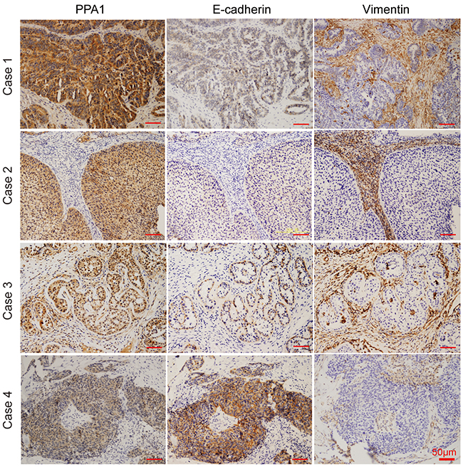 IHC staining revealed correlations between PPA1 and E-cadherin or Vimentin in EOC samples.