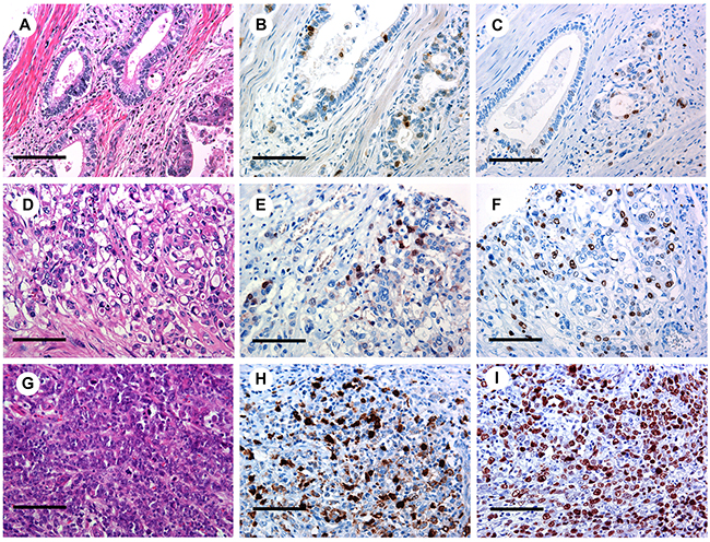 BUB1 and Ki-67 expression in gastric adenocarcinoma.