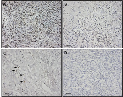 Exemplificative pictures of immunohistochemical staining of SOX2 showing different expression levels in BC tissues.