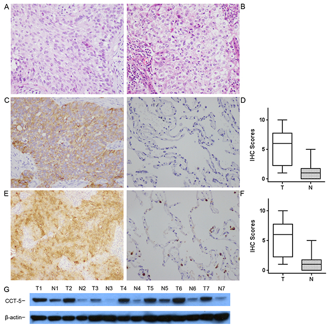 The expression of CCT5 in cancer and non-cancer epithelium were assessed by immunohistochemistry with monoclonal antibodies.