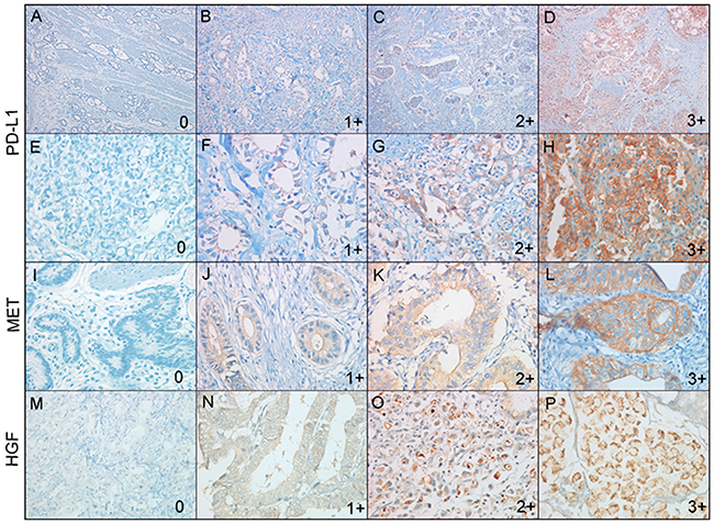 Representative immunohistochemical images of PD-L1, MET, and HGF expressions in gastric carcinomas.