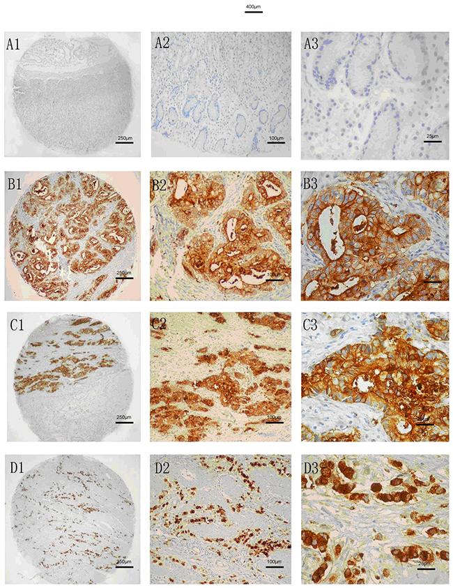 CEACAM6 staining analysis in normal and gastric cancer tissues.