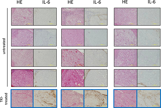 Immunohistochemical staining of IL-6 in specimens of RCC patients treated with TKIs or without therapy before nephrectomy.