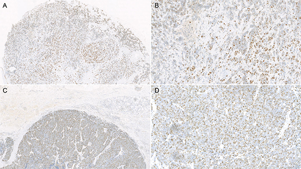 Microscope photographs of immunohistochemistry stain of Ki-67 expression in esophageal small cell carcinoma: Low expression of Ki-67 (&#x003C; 50%, A: &#x00D7;40; B: &#x00D7;200) and high expression of Ki-67 (&#x003E; 50%, C: &#x00D7;40; D: &#x00D7;200).