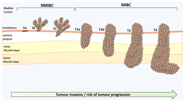 Schematic representation of bladder cancer stage and grade.