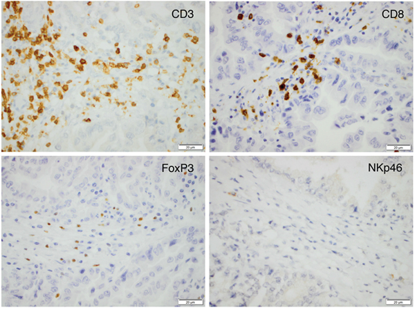Sample immunohistochemical images (magnification x 40) of the investigated immune cell subsets in an esophageal T2N0M0 adenocarcinoma.