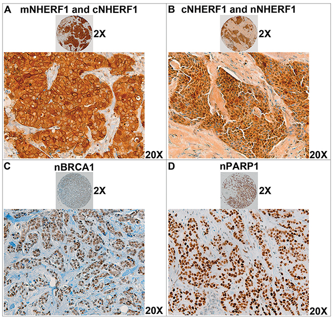 Immunoreactivity of NHERF1, BRCA1 and PARP1 proteins on breast cancer tissue microarrays (TMA).