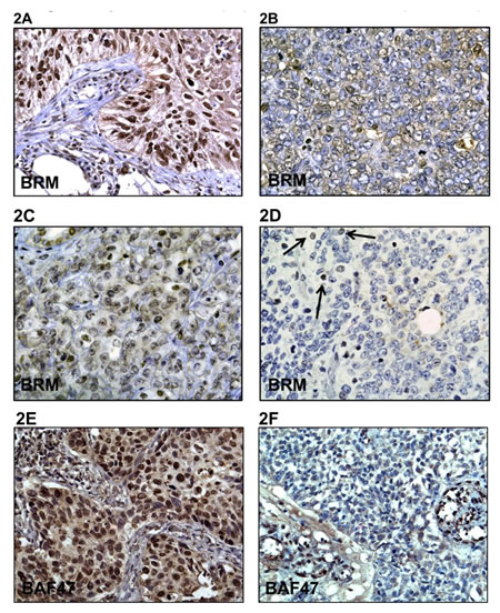 A-F demonstrates immunohistochemical (IHC) staining for BRM in Rhabdoid tumors and in a positive control lung cancer as well as staining for BAF47 in Rhabdoid tumors.