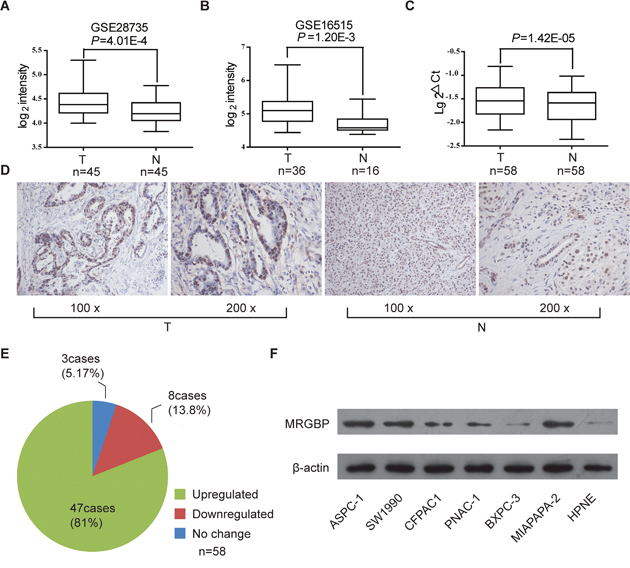 The expression of MRGBP is increased in pancreatic ductal adenocarcinoma (PDAC).