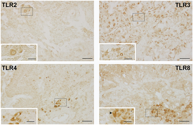 Representative images of TLRs in human neoplastic lung tissue.