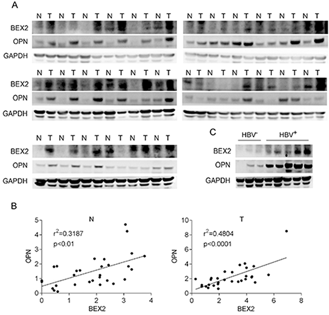 Enhanced expression of BEX2 and OPN in human HCC specimens.