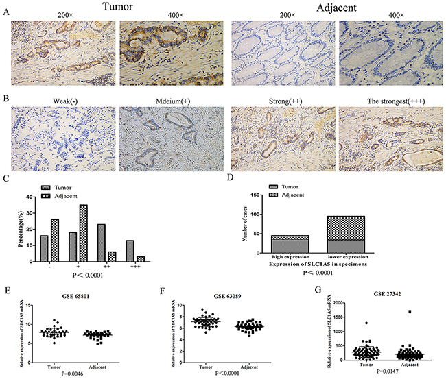 SLC1A5 was highly expressed in gastric cancers.