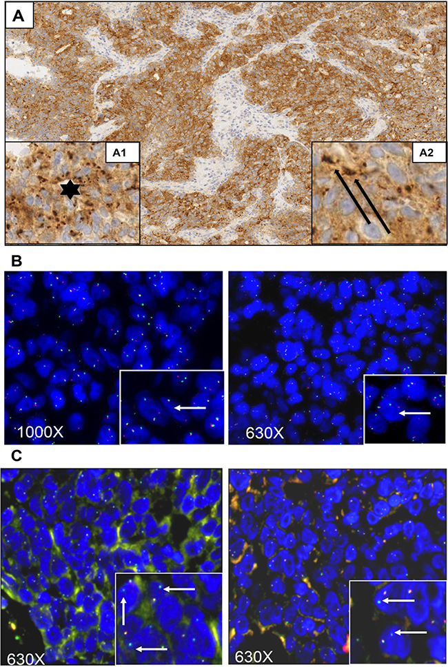 Histologic, immunohistochemical, and fluorescence-in-situ hybridization analyses of the case presented.