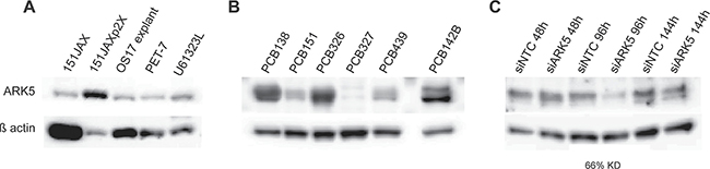 ARK5 expression is present within source tumors and is prevalent in human osteosarcomas.