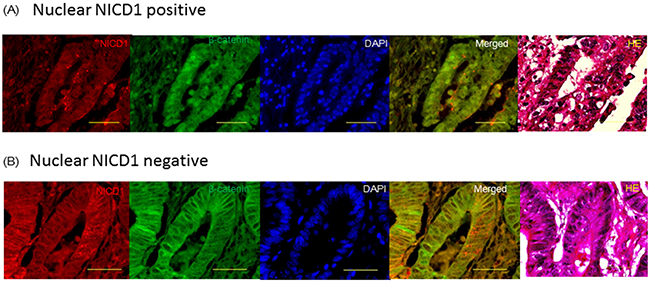 Confocal imaging of immunohistochemistry analysis of &#x03B2;-catenin and NICD1 in colon cancer tissues.