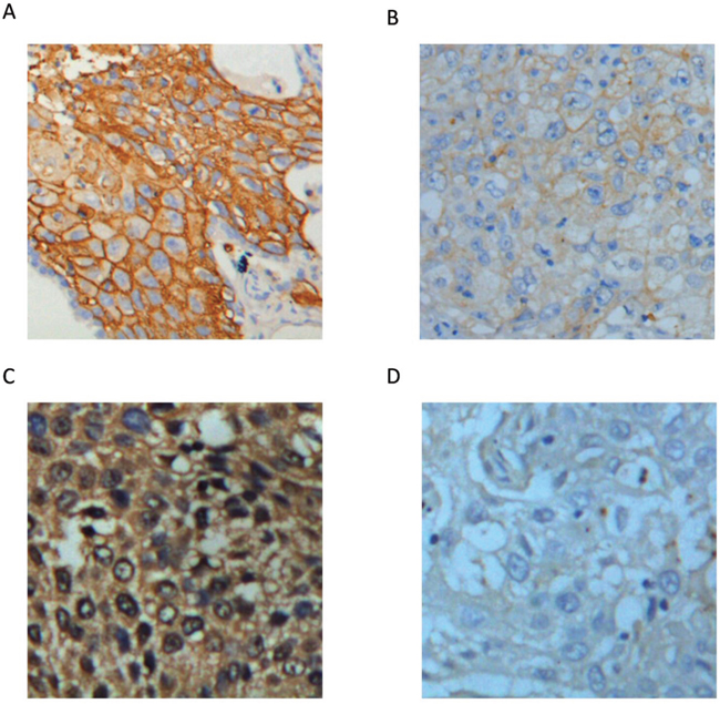 Representative images of GLUT1 and HK2 expression in lung cancer tissues (400&#x00D7;).