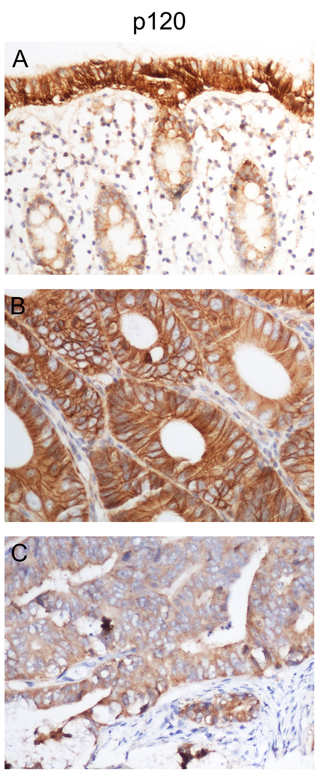 p120 is downregulated in human colon cancer tissues.
